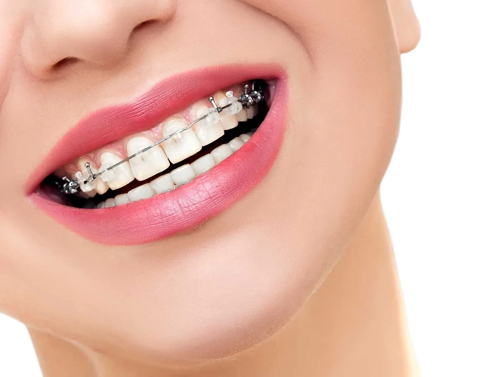 Metal Brackets