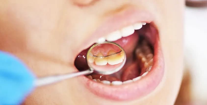 Lingual Orthodontics