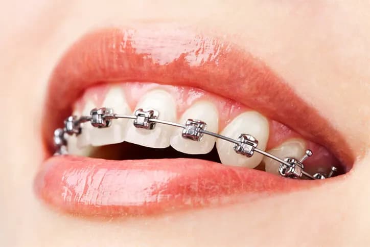 Preventive Orthodontic Treatment