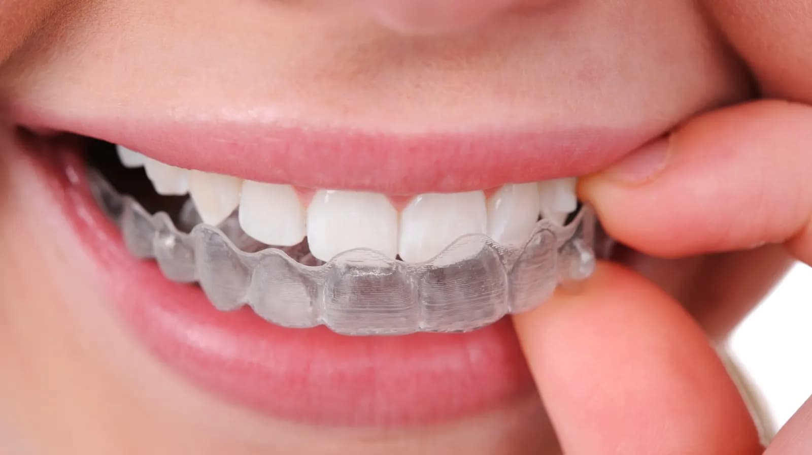 Invisalign (Clear Aligners)