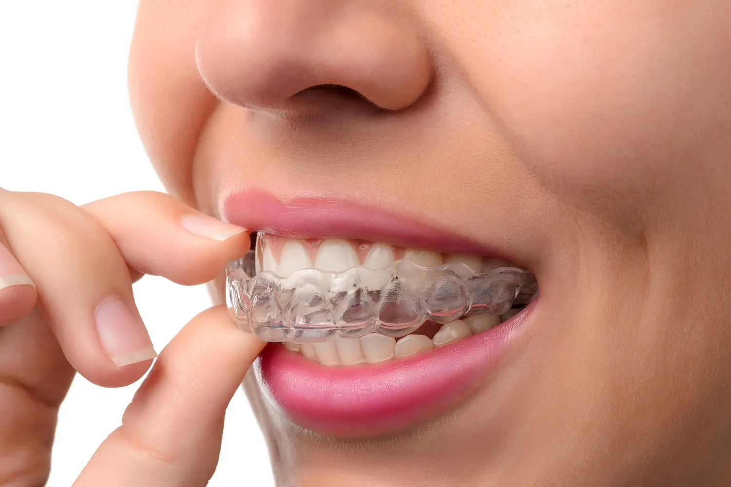 Qu’est-ce que le traitement orthodontique ?