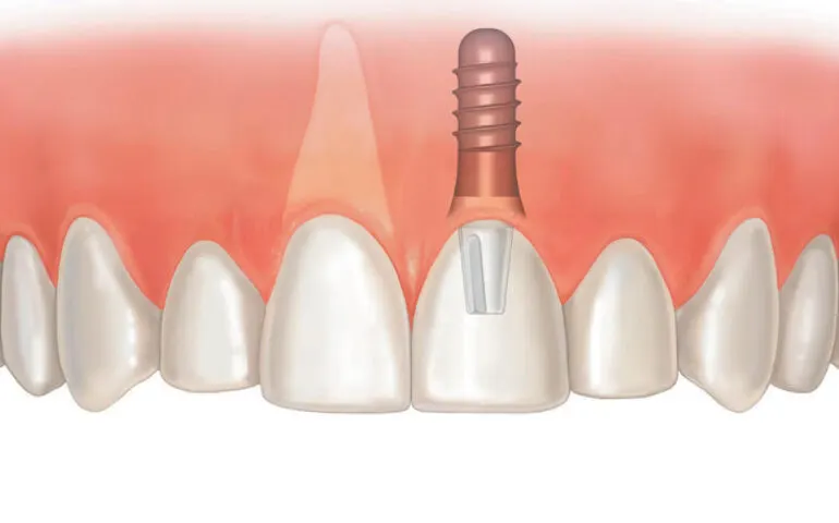 Implants dentaires