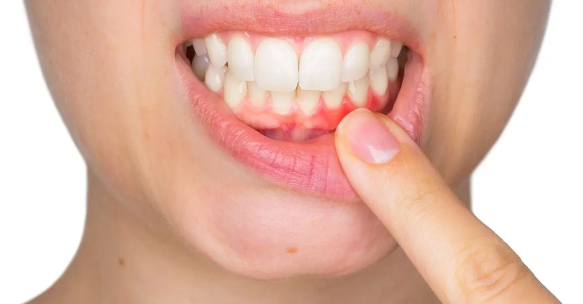 Qu’est-ce que l’inflammation des gencives ?
