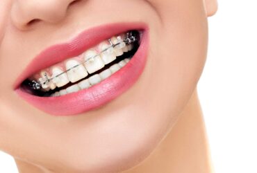 Metal Braketler