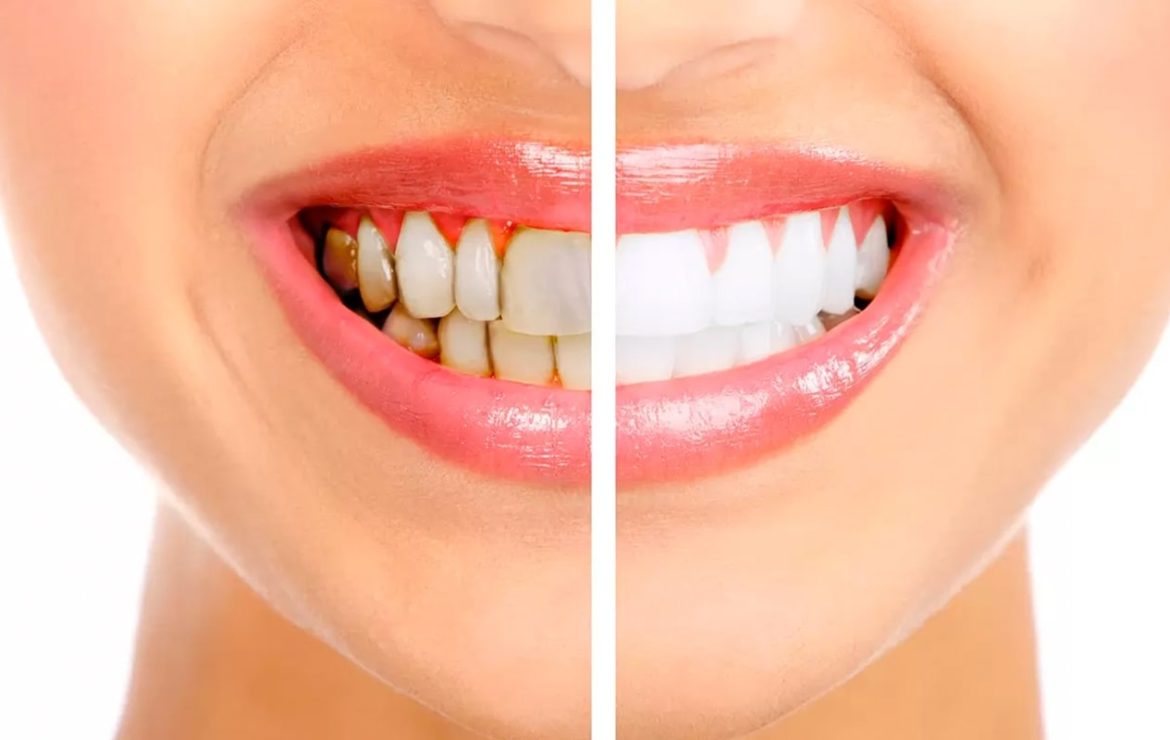 Diş Taşı Temizliği Neden Bu Kadar Önemli?