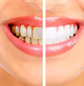 Diş Taşı Temizliği Neden Bu Kadar Önemli?