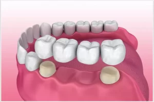 Diş Köprüsü Nedir? Tedavi Süreci Nasıldır? Nişantaşı’nda Diş Köprüsü Nerede Yaptırabilirim?