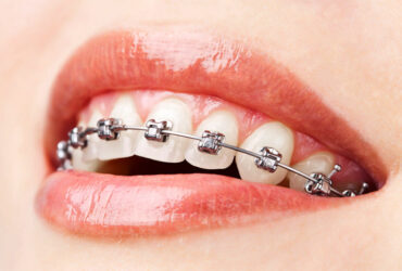 Önleyici Ortodontik Tedavi