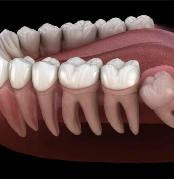 Gömülü Diş Ameliyatı Nasıl Yapılır?