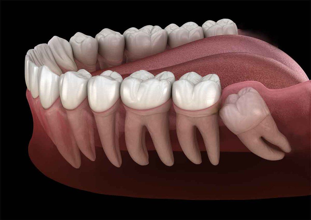 Gömülü Diş Ameliyatı Nasıl Yapılır?